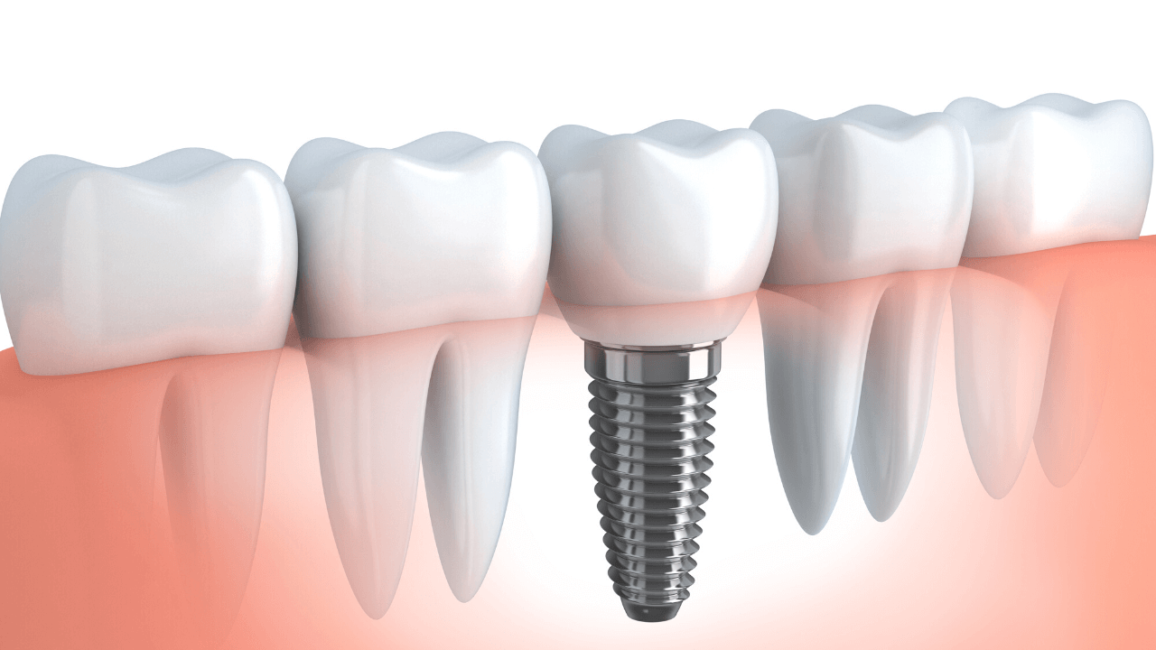 Gli impianti dentali
