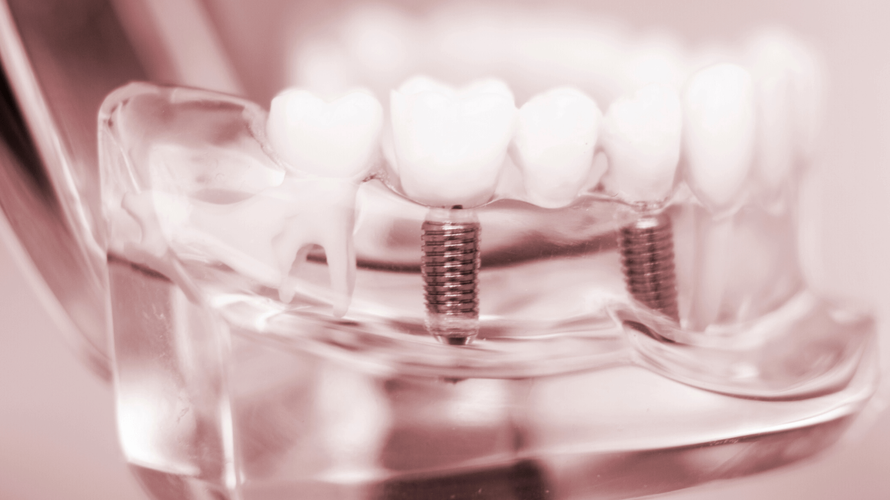 Si può sviluppare “rigetto” verso un impianto dentale?