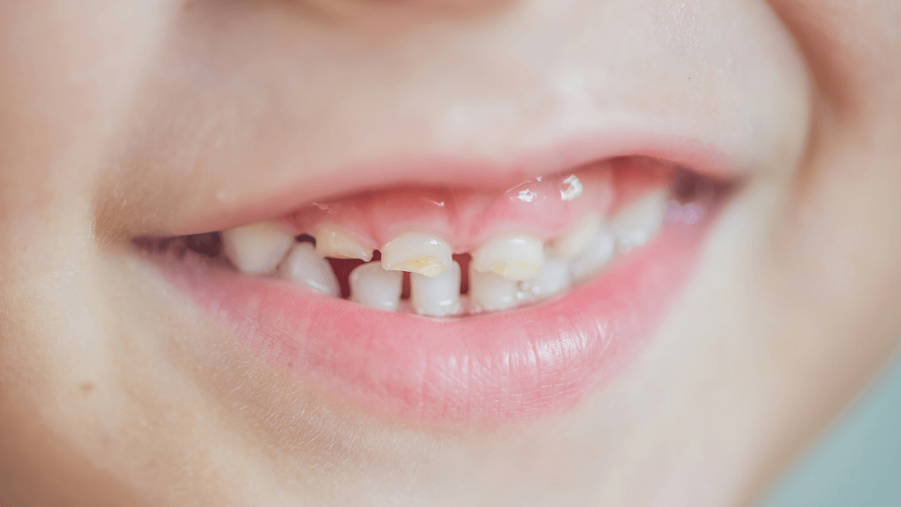 Dente rotto: cosa fare in caso di trauma dentale