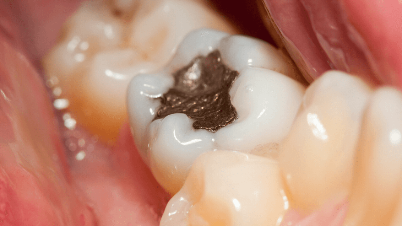 Amalgama Dentale
