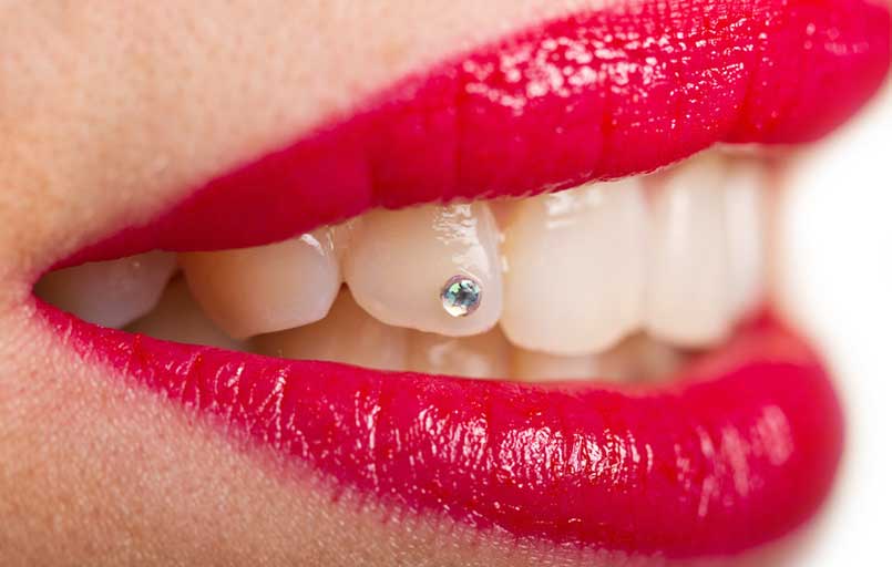 Il brillantino ai denti: come si applica e cosa comporta?