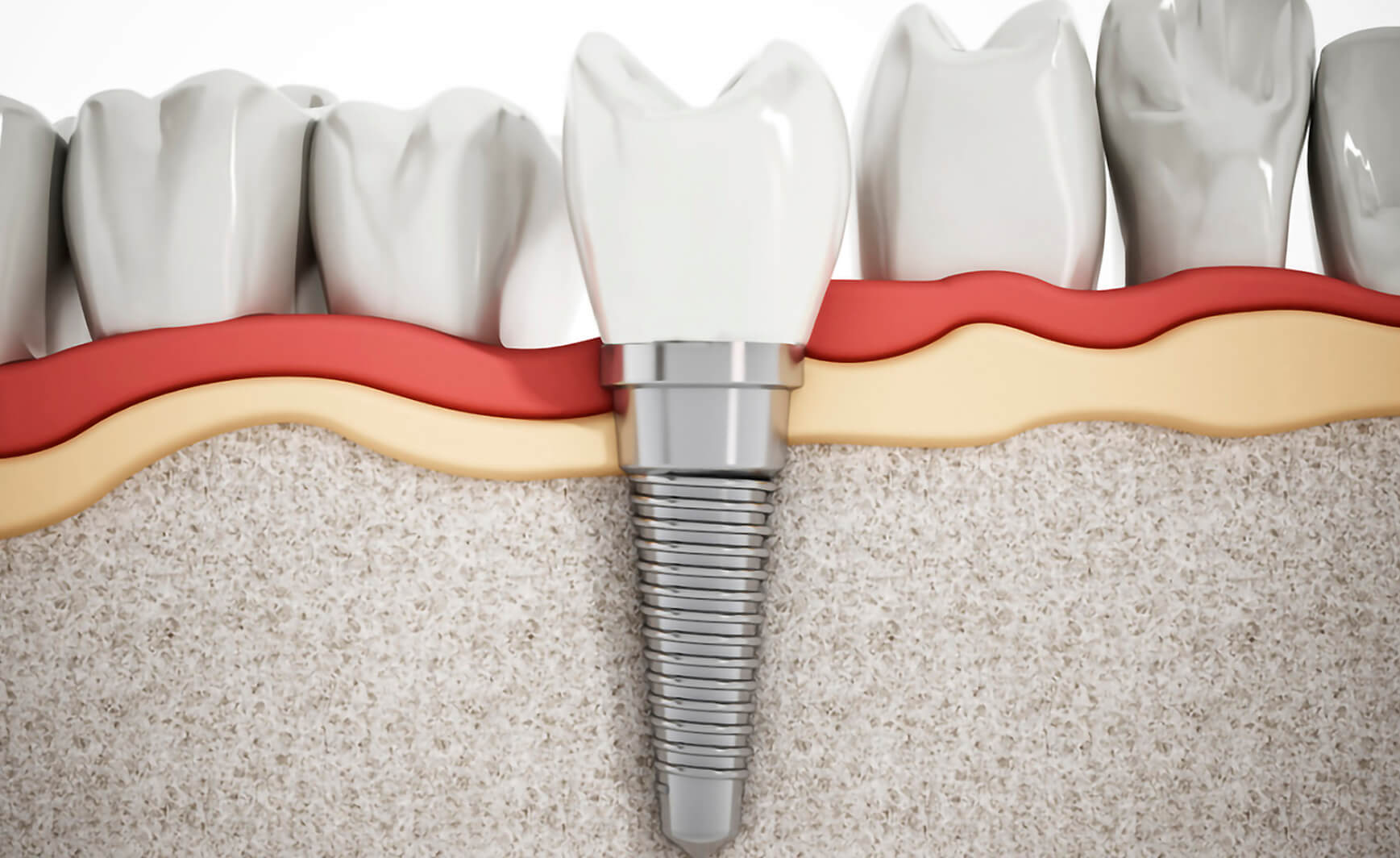 Disegno/immagine di un impianto denatle