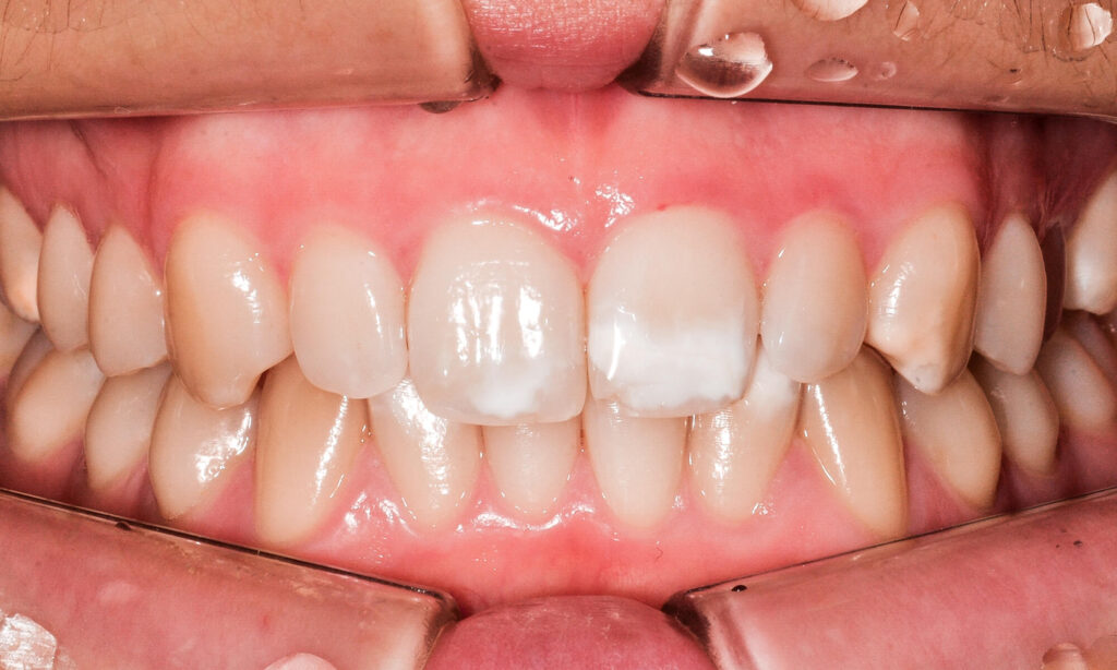 Immagine di un sorriso con in primo piano una "white spot", una macchia bianca antiestetica che è possibile togliere.