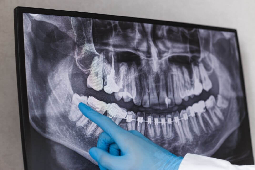 Quanto Costa Estrazione Dente Del Giudizio
