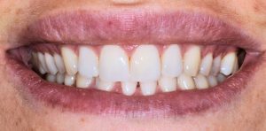 Sorriso con faccette dentali applicate agli incisivi