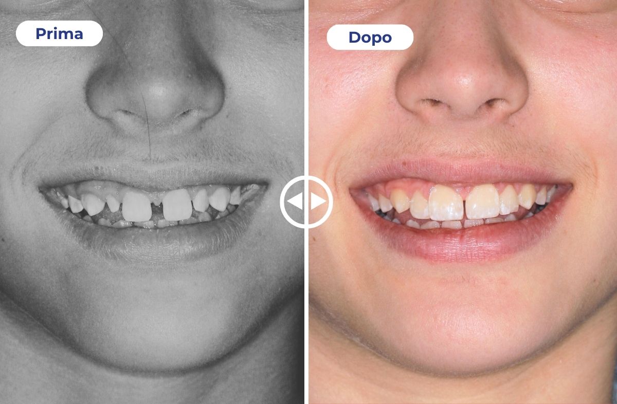 Un caso studio che mostra il prima e dopo l'applicazione di faccette estetiche.