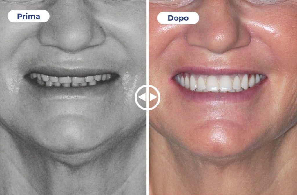 Un caso studio che mostra il prima e dopo di una protesi totale