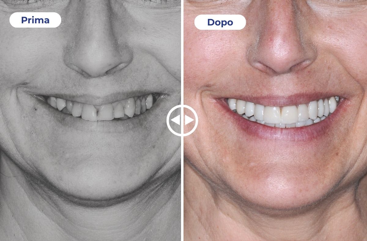 Un caso studio che mostra il prima e dopo l'applicazione di faccette estetiche.