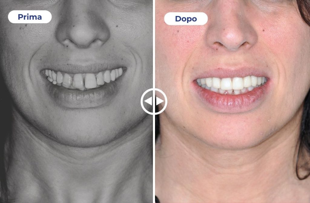 Un caso studio che mostra il prima e dopo di una protesi estetica