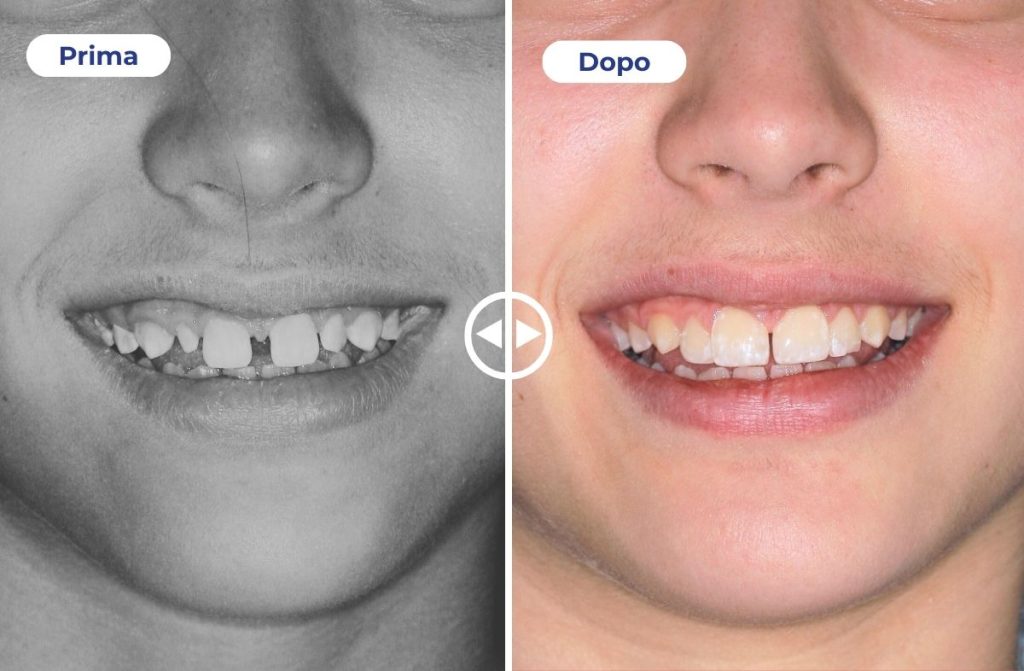 Un caso studio che mostra il prima e dopo l'applicazione di faccette estetiche.