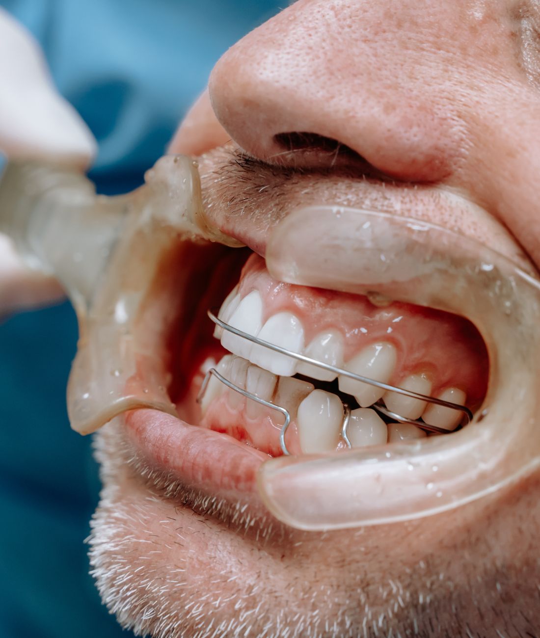 Dettaglio della bocca di un paziente durante un controllo di un trattamento di ortodonzia mobile.