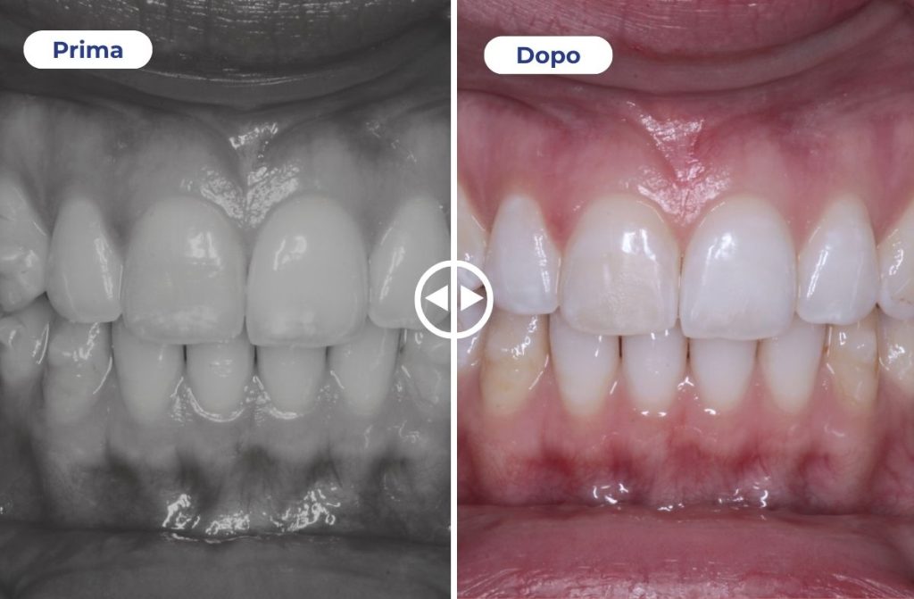 Nell'immagine si vedono gli incisivi superiori prima e dopo il trattamento White Spot