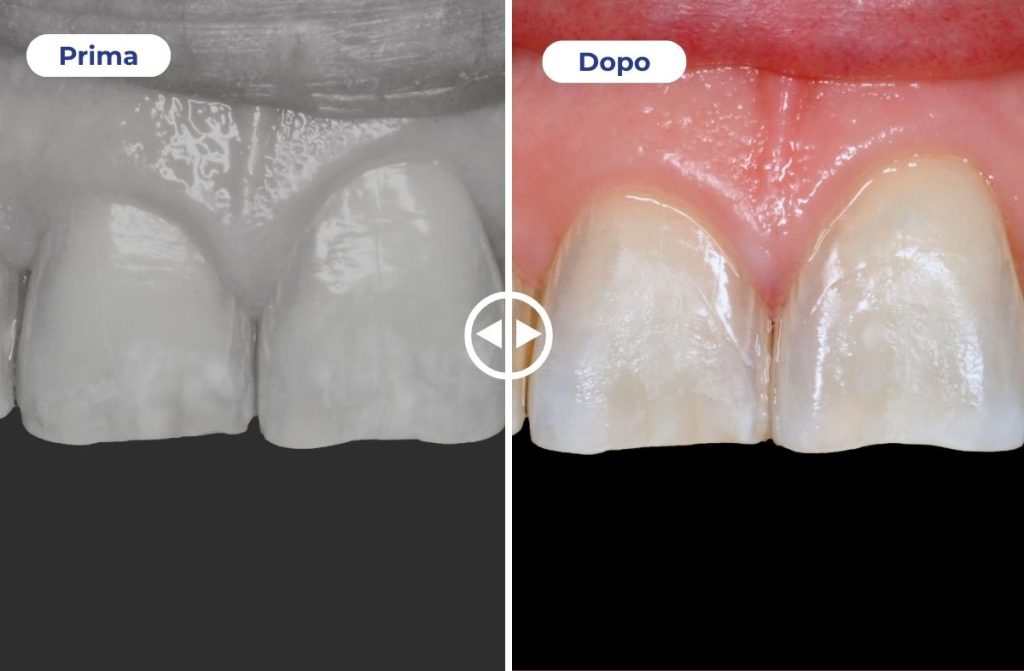 Nell'immagine si vedono gli incisivi superiori prima e dopo il trattamento White Spot