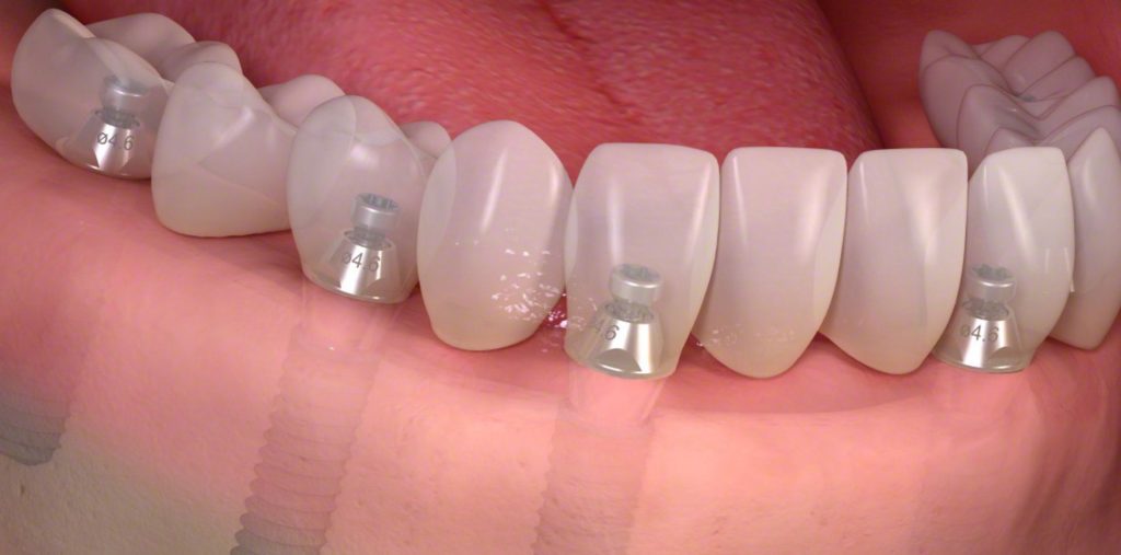 simulazione di un impianto dentale