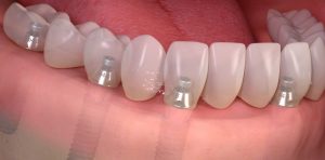 simulazione di un impianto dentale