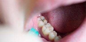 Immagine di un dente cariato