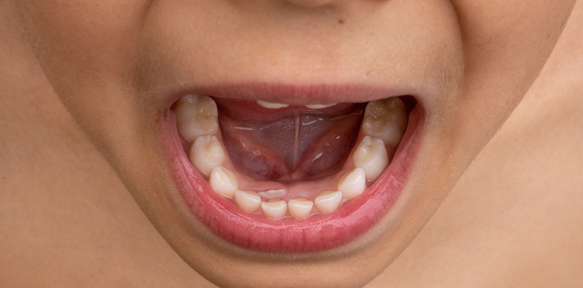 Foto di una bocca di un bambino con denti in doppia fila