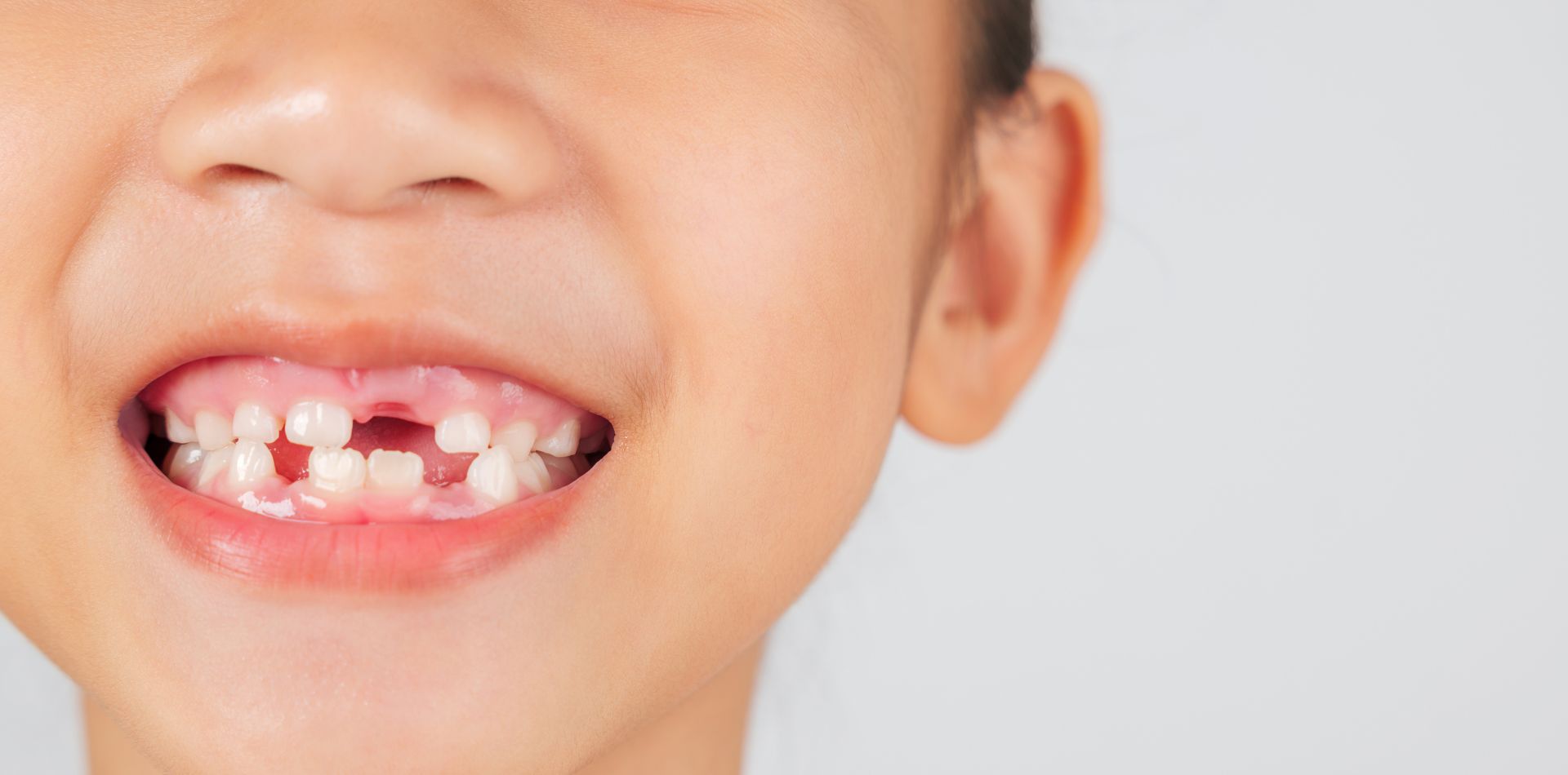 Foto di un bambino con dentatura da latte