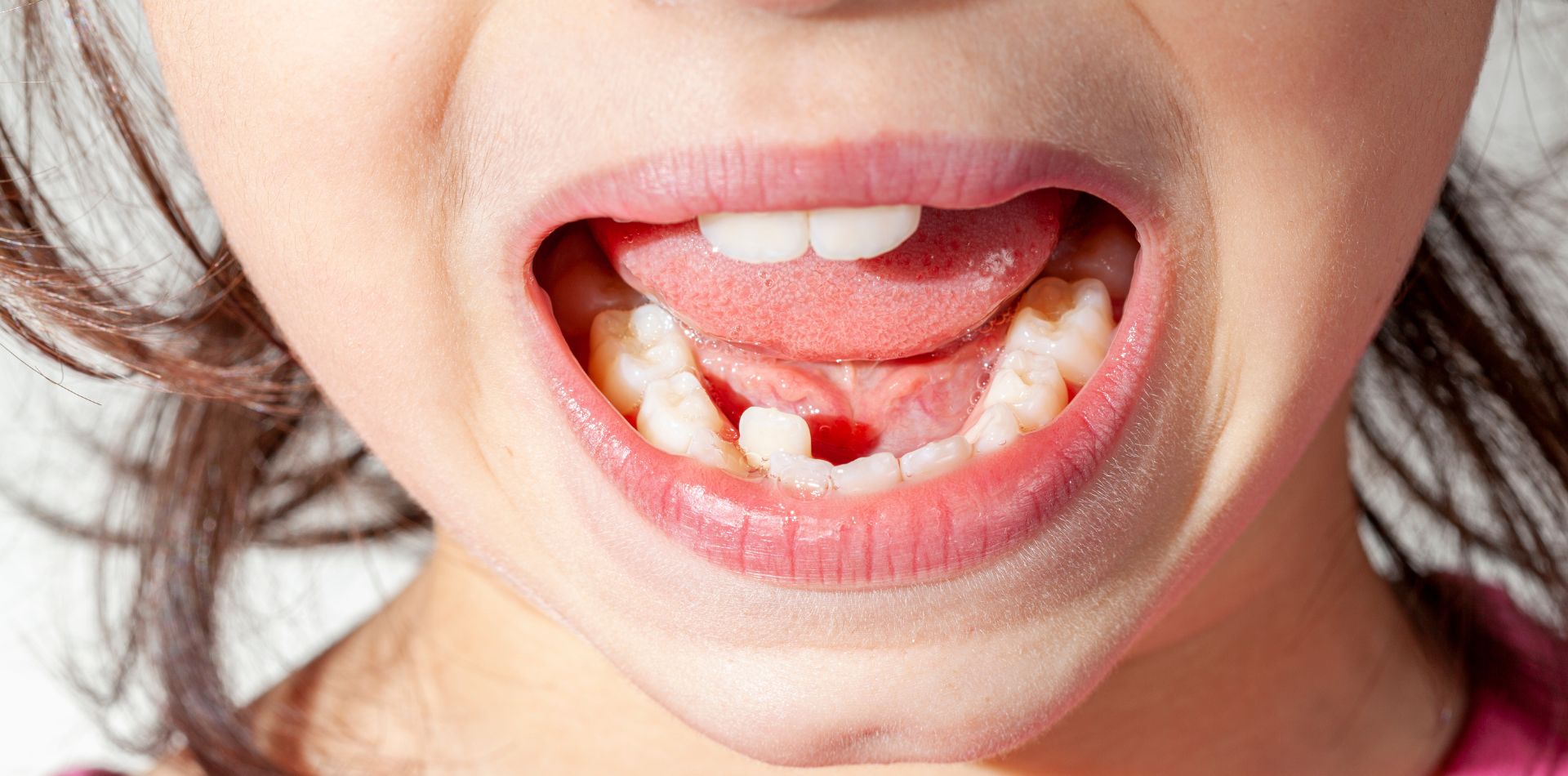 La bocca di una bambina in cui si vedono i denti accavallati